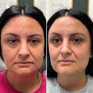Before and after photo of patient after being treated with morpheus8