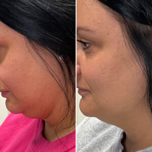 Before and after photo of patient after being treated with morpheus8
