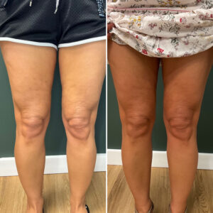 Before and after photo of patient's legs after being treated with morpheus8