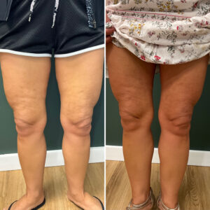 Before and after photo of patient's legs after being treated with morpheus8