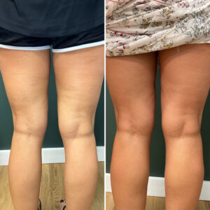 Before and after photo of patient's legs after being treated with morpheus8