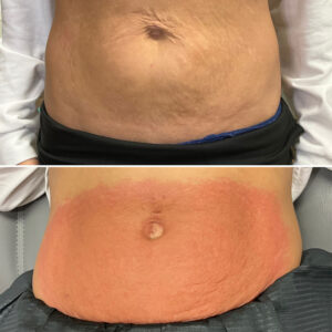 Before and after photo of patient's navel and lower belly after being treated with morpheus8