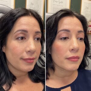 Before and after photo of patient after being treated with midface dermal filler