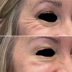 Before and after photos of a patient after crows feet being treated with wrinkle relaxer