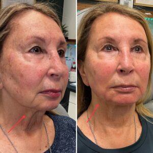 Before and after photo of patient after being treated with jawline dermal filler