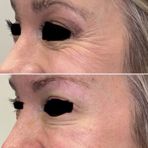 Before and after photos of a patient after crows feet being treated with wrinkle relaxer