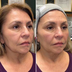 Before and after photo of patient after being treated with midface filler