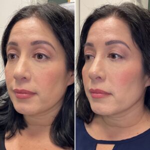Before and after photo of patient after being treated with midface filler