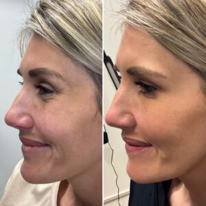 Before and after photos of a patient after crows feet being treated with wrinkle relaxer