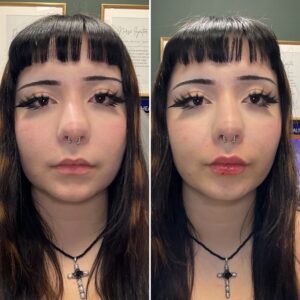 Before and after photo of patient after being treated with midface and lip filler