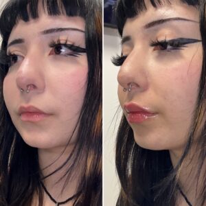 Before and after photo of patient after being treated with midface and lip filler