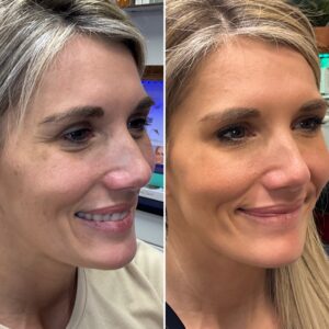 Before and after photos of a patient after crows feet being treated with wrinkle relaxer