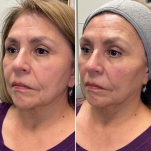 Before and after photo of patient after being treated with midface dermal filler