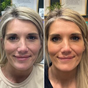 Before and after photos of a woman smiling showing the results of treating with wrinkle relaxer