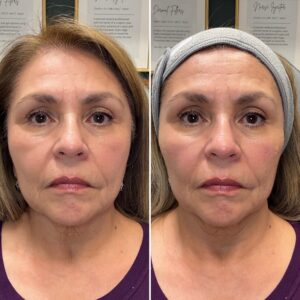 Before and after photo of patient after being treated with midface filler