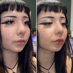 Before and after photo of patient after being treated with midface and lip filler