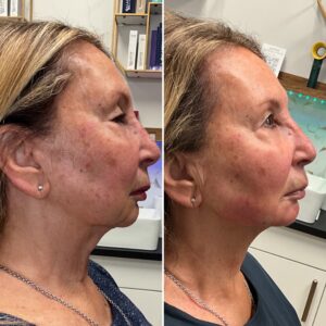 Before and after photo of patient after being treated with midface dermal filler