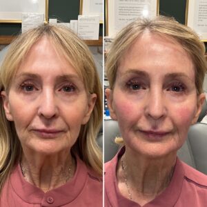 Before and after photo of patient after being treated with midface dermal filler
