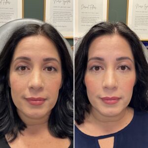 Before and after photo of patient after being treated with midface dermal filler