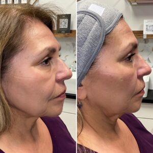 Before and after photo of patient after being treated with midface filler