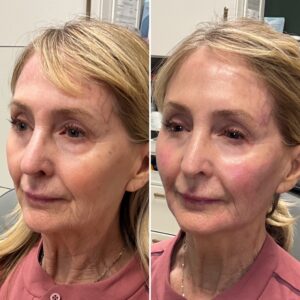 Before and after photo of patient after being treated with midface filler