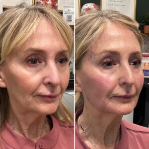 Before and after photo of patient after being treated with midface filler