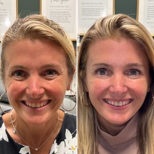 Before and after photos of a woman smiling showing the results of treating with wrinkle relaxer