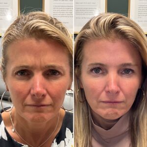 Before and after photo of a patient after being treated with wrinkle relaxer to the glabella