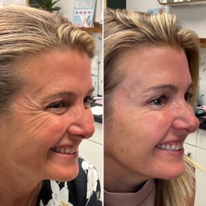 Before and after photos of a patient after crows feet being treated with wrinkle relaxer