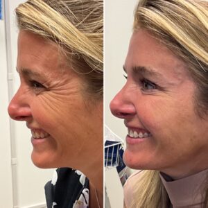 Before and after photos of a woman after crows feet being treated with wrinkle relaxer