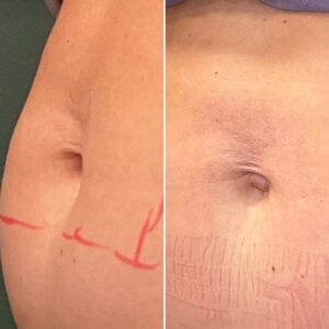 Before and after photo of a navel after treatment with morpheus8