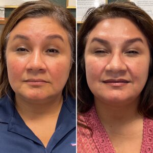 Before and after photos showing the results after treating forehead lines