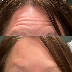 Before and after photos showing the results after treating forehead lines