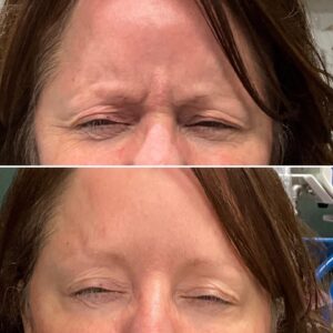 Before and after results showing treatment to the glabella
