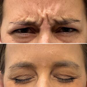 Before and after results showing treatment to the glabella