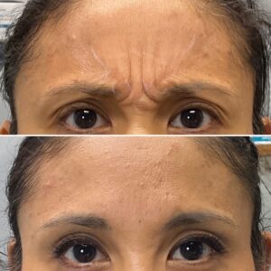 Before and after results showing treatment to the glabella
