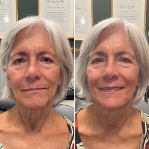 Before and after photo of patient after being treated with midface filler