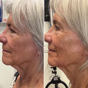 Before and after photo of patient after being treated with midface filler