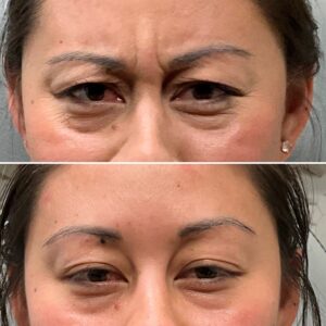 Before and after results showing treatment to the glabella