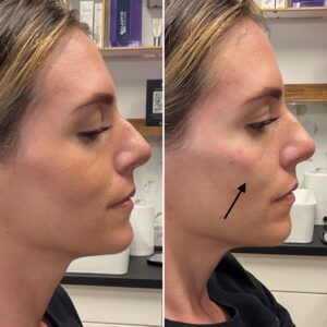 Before and after photo of patient after being treated with midface dermal filler