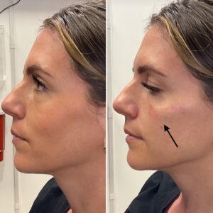 Before and after photo of patient after being treated with midface filler