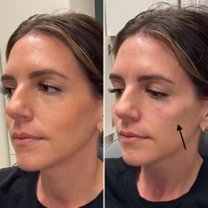 Before and after photo of patient after being treated with midface filler