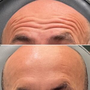 Before and after photos showing the results after treating forehead lines