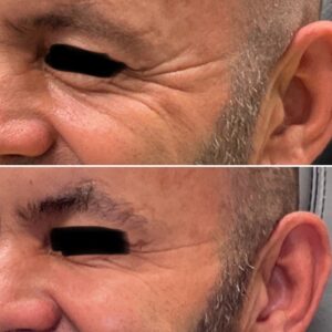 Before and after photos of a man after crows feet being treated with wrinkle relaxer