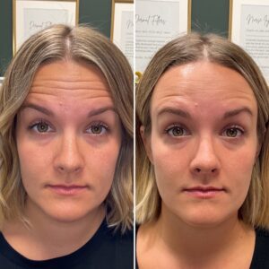Before and after photos showing the results after treating forehead lines