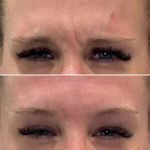 Before and after results showing treatment to the glabella