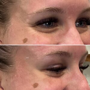 Before and after photos of a woman after crows feet being treated with wrinkle relaxer