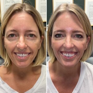 Before and after photos of a woman smiling showing the results of treating with wrinkle relaxer